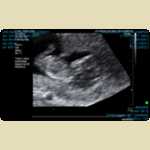 Ultrasounds of Baby Mortimer -  4 of 11