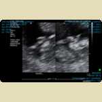 Some early ultrasounds of Jai, approximately 11 weeks after conception, when he was just 47.9mm (4.8cm) long. His heart was beating at 158bpm when we had these pictures taken at the Joondalup hospital.