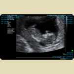 Ultrasounds of Baby Mortimer -  11 of 11